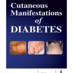 Cutaneous Manifestations of Diabetes - Clinical Guide