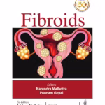 Fibroids - Medical Textbook