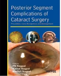 Posterior Segment Complications of Cataract Surgery Prev.,Early Recog.And Management - 1st Edition