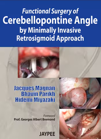 Functional Surgery of Cerebellopontine Angle By Minimally Invasive Retrosigmoid Approach - 1st Edition