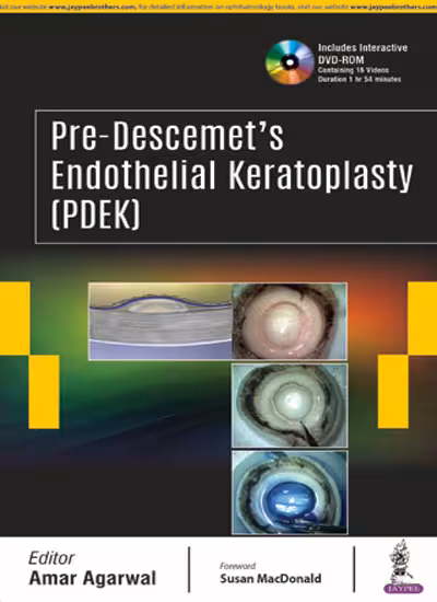 Pre-Descemet'S Endothelial Keratoplasty(Pdek) - 1st Edition
