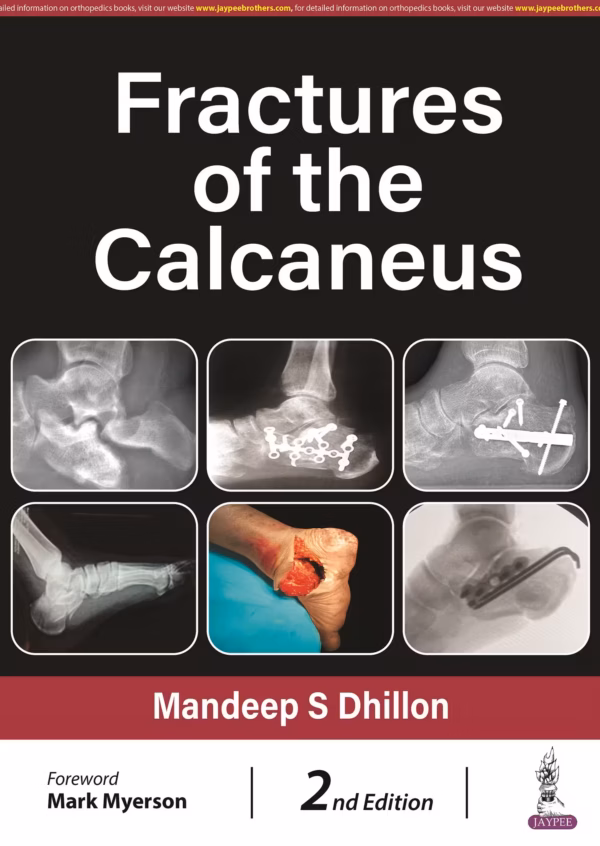 Fractures of the Calcaneus - 2nd Edition
