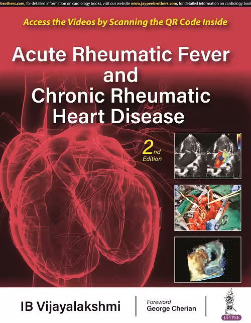 Acute Rheumatic Fever and Chronic Rheumatic Heart Disease - 2nd Edition