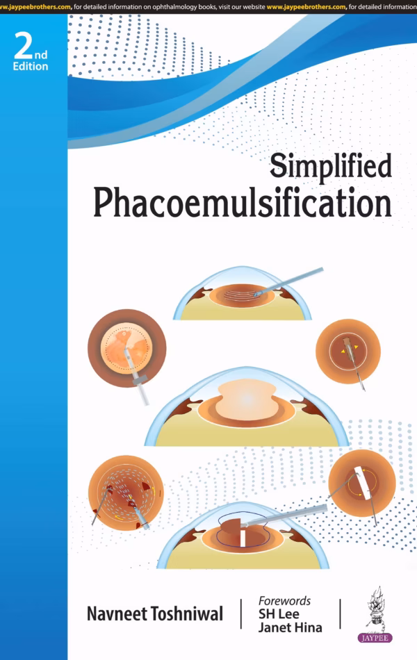 Simplified Phacoemulsification - 2nd Edition