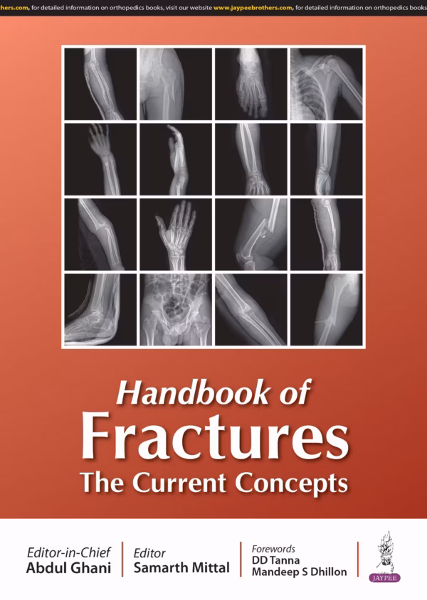 Handbook of Fractures the Current Concepts - 1st Edition