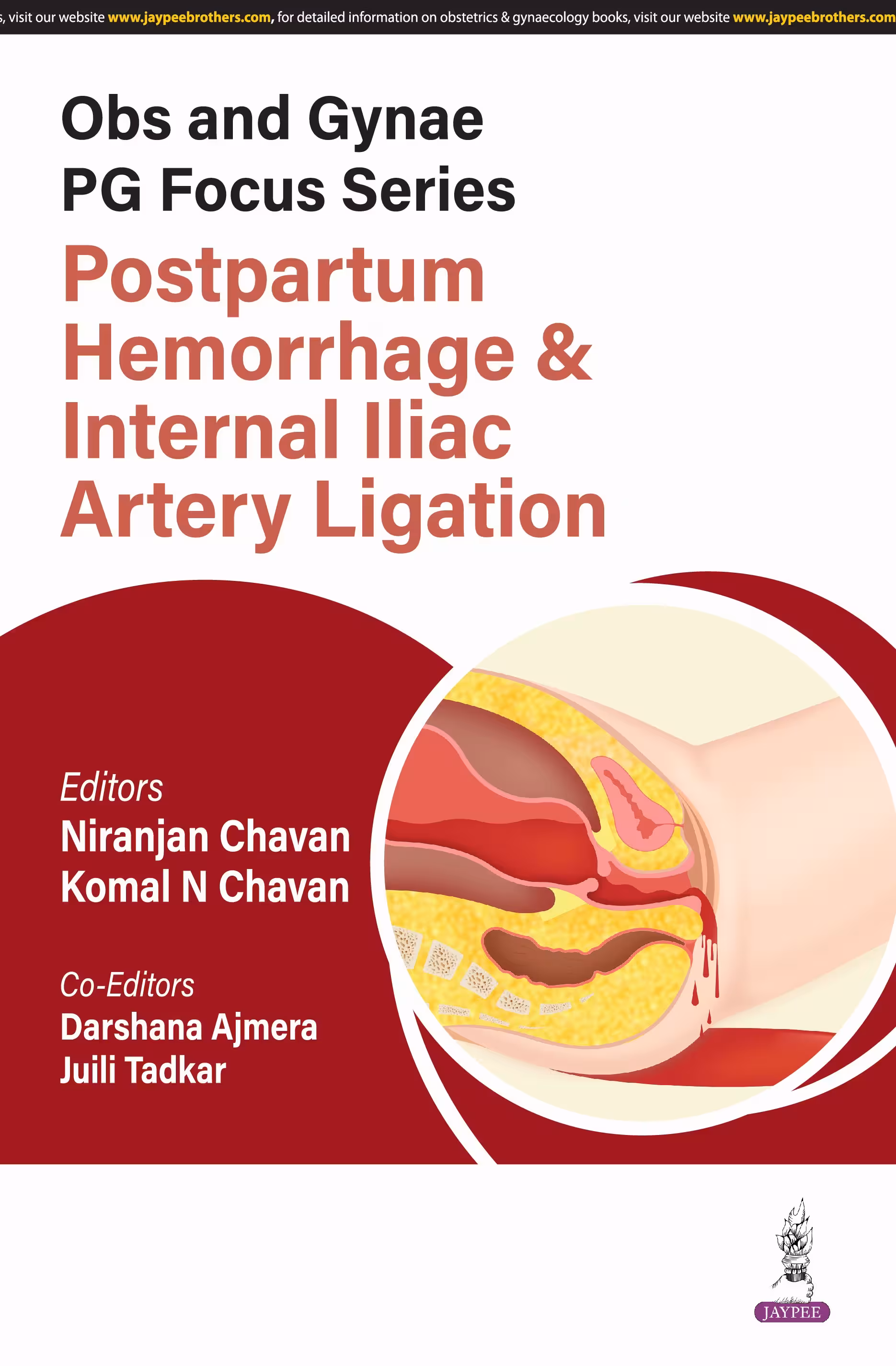 Obs and Gynae Pg Focus Series Postpartum Hemorrhage & Internal Iliac Artery Ligation - 1st Edition